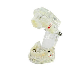 Dental Implant Teaching Model with Restoration & Bridge