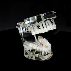 Dental Implant Teaching Model with Restoration & Bridge