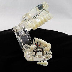 Dental Implant Teaching Model with Restoration & Bridge